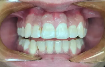 AUR - after Invisalign 31