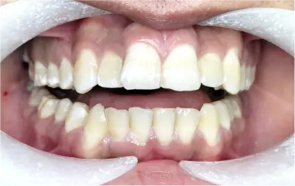 AUR - before Invisalign 31