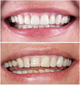 Can Veneers Be Removed permanent