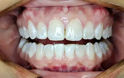 Invisalign in chatswood case 31 after