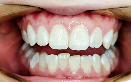 Invisalign in chatswood case before