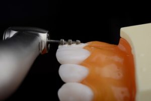 Veneers Philippines procedure Veneers Philippines procedure