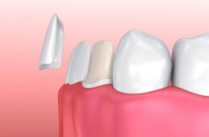 can you get veneers with receding gums procedure