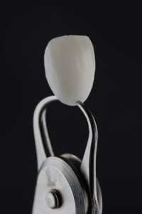 can you get veneers with receding gums shells