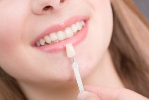 veneers Philippines cost material veneers Philippines cost material
