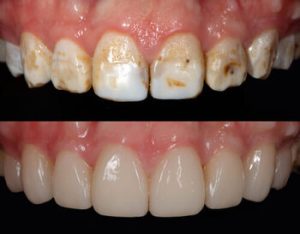How Old Do You Have To Be To Get Veneers before after