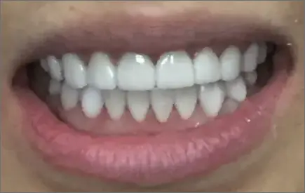 Invisalign in chatswood case 2 after
