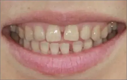 Invisalign in chatswood case 2 before