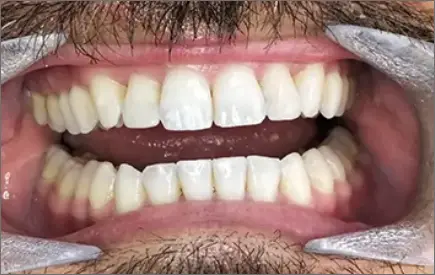 Invisalign in chatswood case 3 after