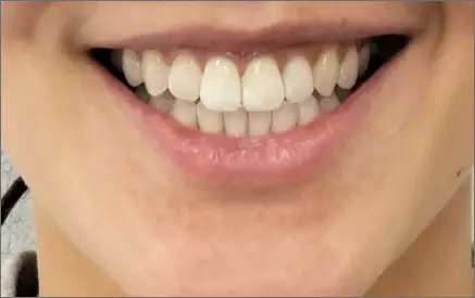 Invisalign in chatswood case 4 after