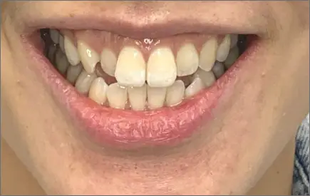Invisalign in chatswood case 4 before