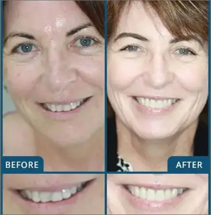 Invisalign and Veneers in Chatswood Case 2