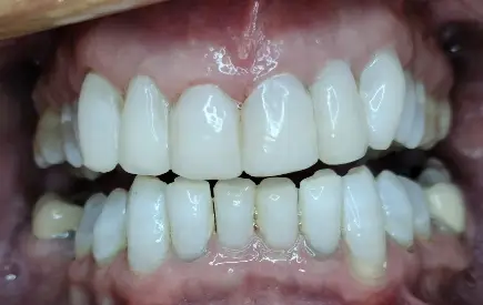 Invisalign Case 8 before-after