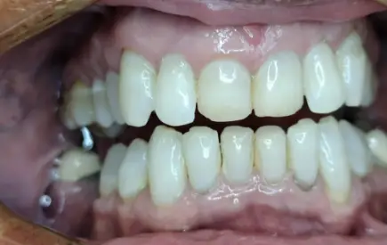 Invisalign Case 8 before-after