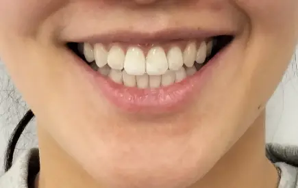 Invisalign Case-34 before-after