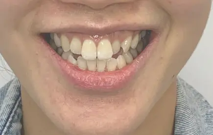 Invisalign Case-34 before-after