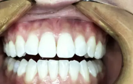 Invisalign Case -35 before-after