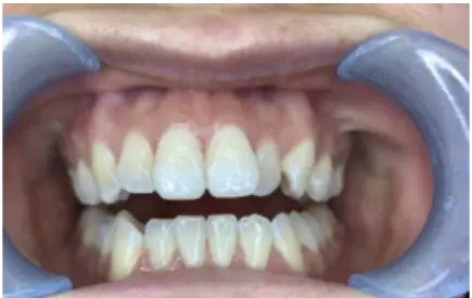 Invisalign Case -35 before-after
