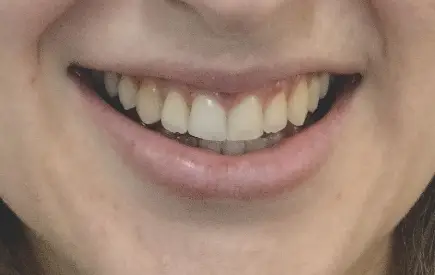 Invisalign Case-36 before-after