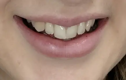 Invisalign Case-36 before-after