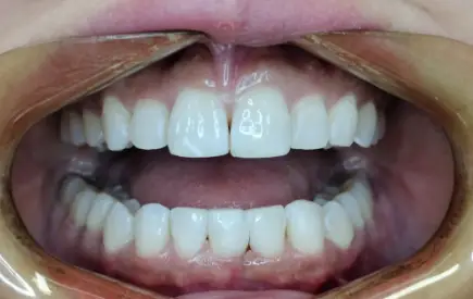 Invisalign Case-37 before-after