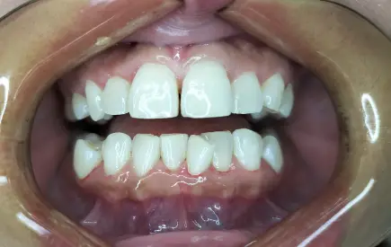 Invisalign Case-37 before-after