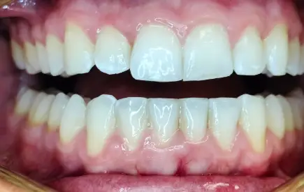 Invisalign Case-48 before-after