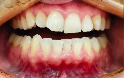 Invisalign Case-48 before-after