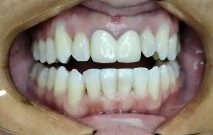 Invisalign Case-49 before-after
