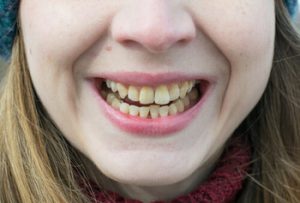 How Long Does a Tooth Filling Take cavities