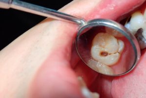 How Long Does a Tooth Filling Take decay