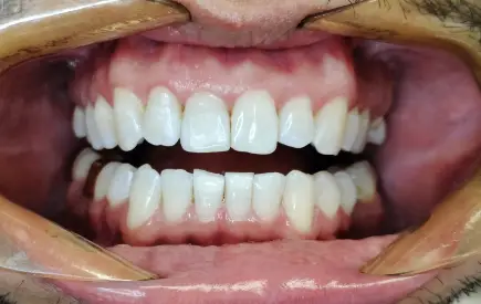Invisalign Case before-after