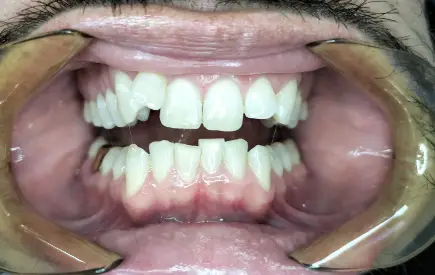 Invisalign Case before-after