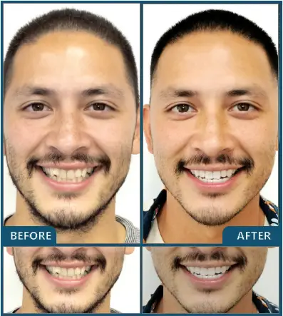 Invisalign in Chatswood Case 47