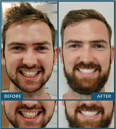 Invisalign in Chatswood Case 49
