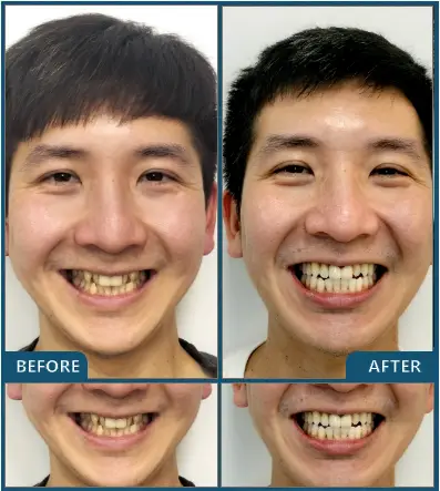 Invisalign in Chatswood Case 48