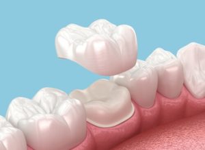 How Long Do Dental Crowns Last single