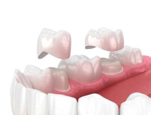 How Long Do Dental Crowns Last types