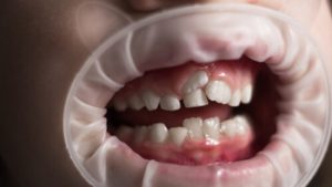 Which Is More Painful Tooth Extraction or Filling issues
