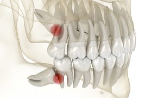 Before and After Wisdom Teeth Removal impacted
