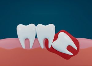 Before and After Wisdom Teeth Removal infection