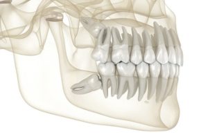 Before and After Wisdom Teeth Removal procedure