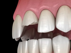 tooth cap vs crown broken