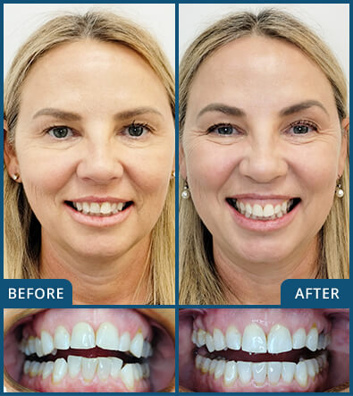 Invisalign in Chatswood Case 1