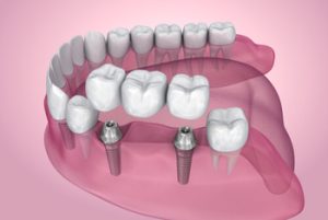 Dental Bridge Infection Symptoms procedure