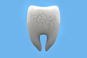Tooth Crown Pain decay