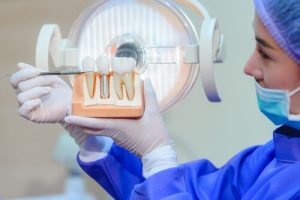 Dental Bone Graft Cost explanation
