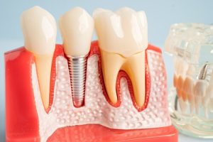 Dental Bone Graft Cost implant