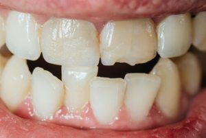 what causes crooked teeth solution