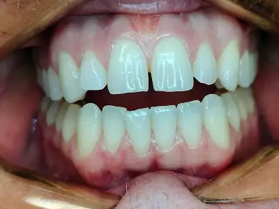 Invisalign Case-1 before-after